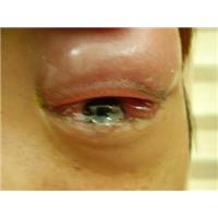 Giảm 10 năm tuổi thọ vì mắc bệnh tiểu đường