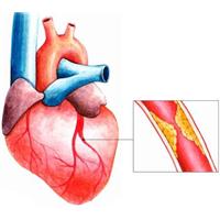 Vai trò của Microalbumin niệu với bệnh lý tim mạch